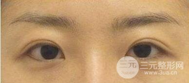 如何预防割双眼皮后有疤痕出现?