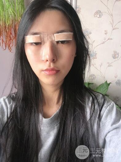 全切双眼皮案例过程记录