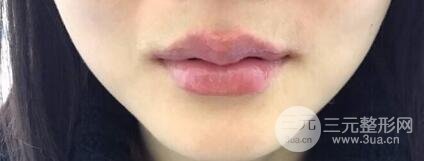 M唇手术对比照：