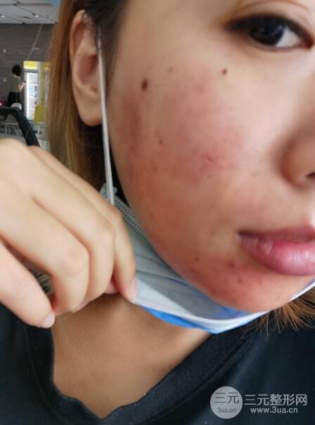 激光祛痘恢复过程图分享
