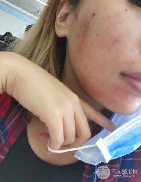 激光祛痘恢复过程图分享