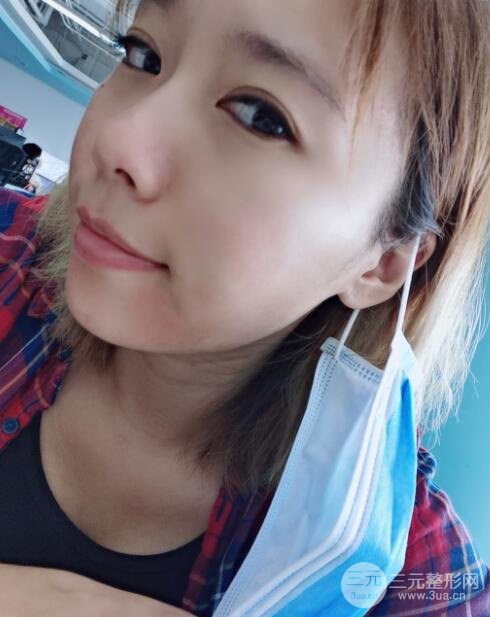 激光祛痘恢复过程图分享