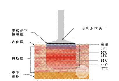 非手术面部除皱除皱果