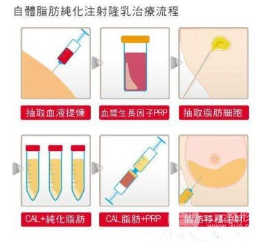隆胸可以喂奶吗