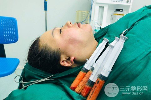 面部吸脂会反弹吗