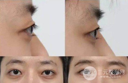 金鱼眼整形前后图片对比