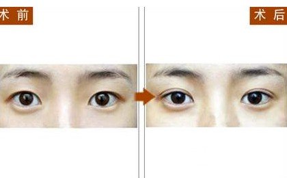 金鱼眼整形前后图片对比