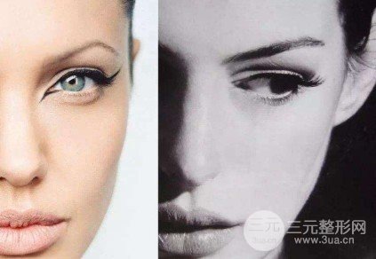 金鱼眼整形前后图片对比