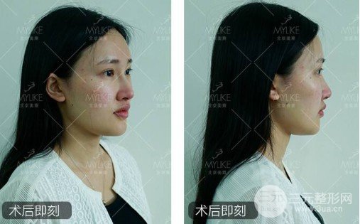 注射隆鼻和假体隆鼻哪个好