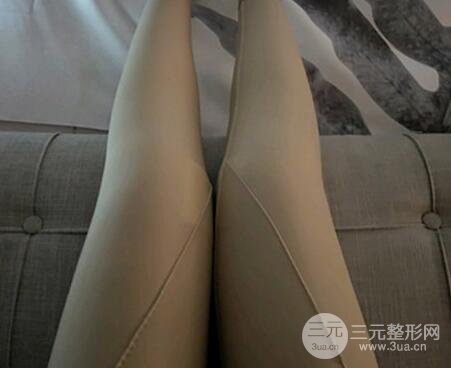 吸脂减肥案例