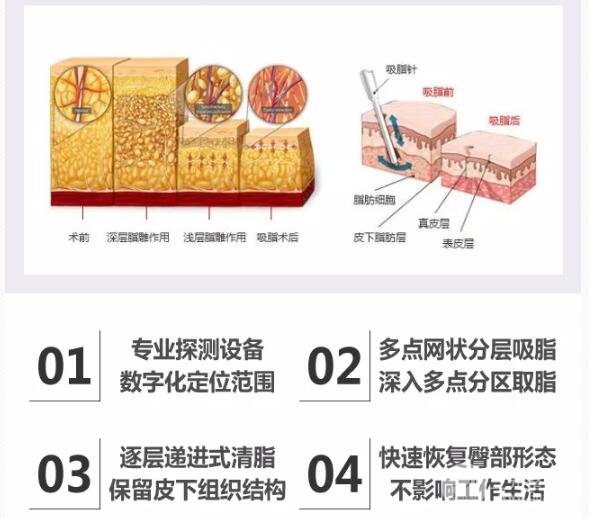 吸脂手术价格: