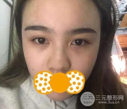 鼻头缩小术后对比照，手术原理解析+注意事项罗列