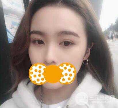 鼻头缩小术后对比照，手术原理解析+注意事项罗列