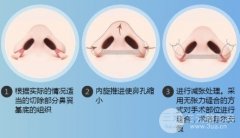 鼻翼缩小整形多少钱?手术后会变形或反弹吗? 鼻翼缩小整形多少钱?手术后会变形或反弹吗?