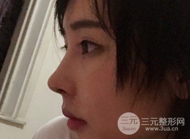 注射隆鼻保持时间