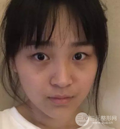 双眼皮宽度6mm