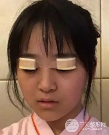 双眼皮宽度6mm