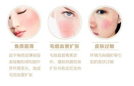 缓解红血丝大概多少钱