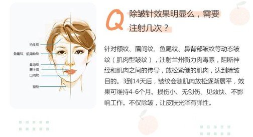 ****注射除皱成好吗