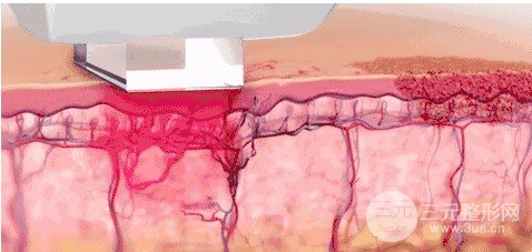 光子嫩肤多久做一次