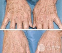 老年斑的消除方法科普—从形成原因选择祛斑方式