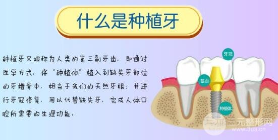 种植牙价格表图
