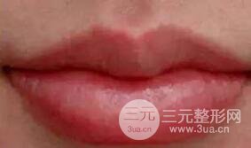 M唇手术步骤：