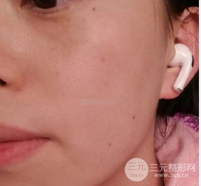 黄褐斑缓解费用高不高