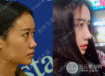 软骨垫鼻子
