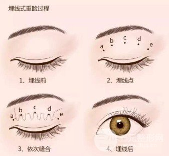 双眼皮手术有几种
