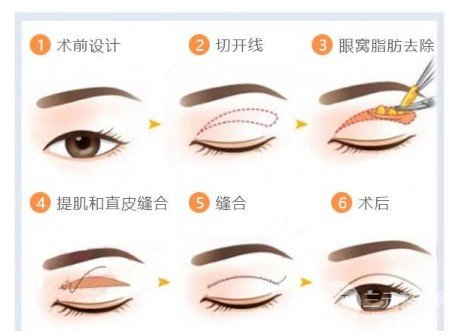 双眼皮手术有几种