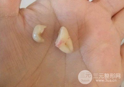 东莞南城固德口腔拔牙多少钱