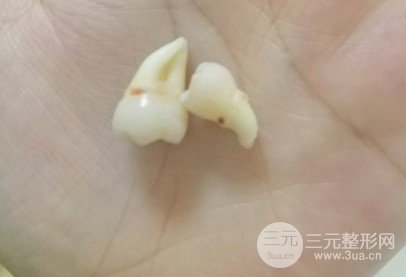 东莞南城固德口腔拔牙多少钱