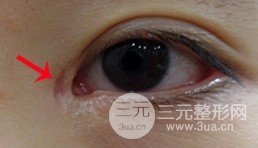 开眼角留疤较严重图片