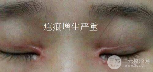 开眼角留疤较严重图片