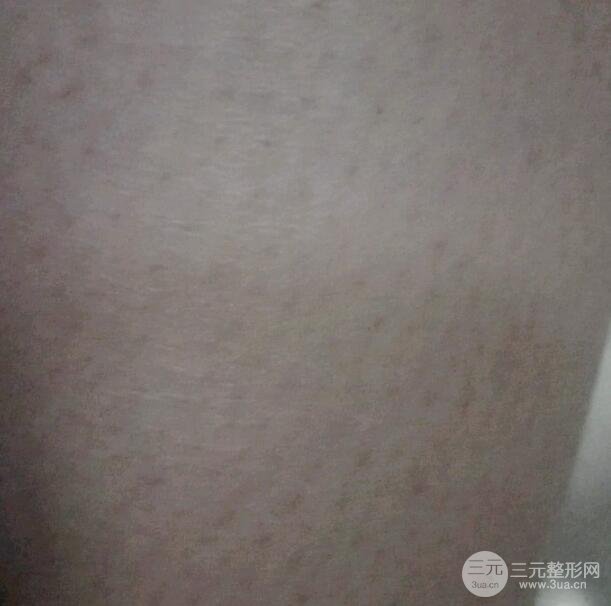 术后半个月的情况