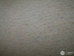 光子嫩肤除毛果如何？来看下真人脱毛除毛果！