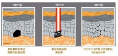 激光可以去除黄褐斑吗?缓解过程及可能的副作用分析