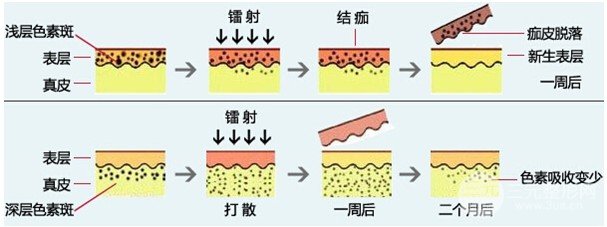 激光可以去除黄褐斑吗