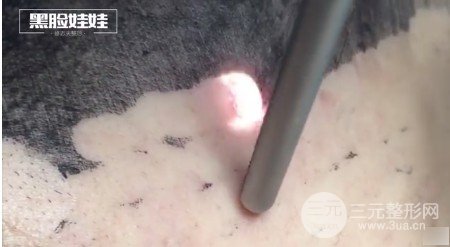 黑脸娃娃嫩肤疼吗