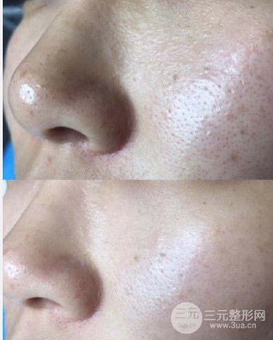 黑脸娃娃嫩肤疼吗