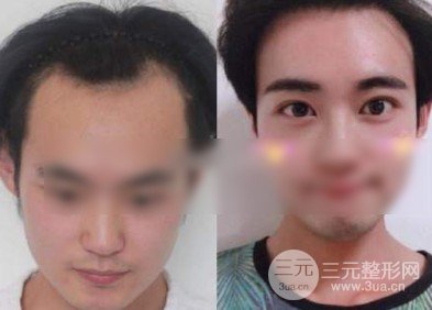 种植毛发技术全过程和果图