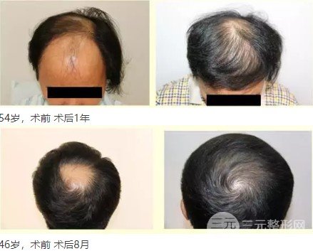 种植毛发技术果图