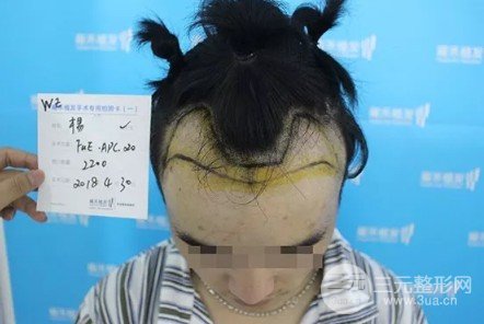 种植毛发技术果图