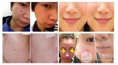 点痦子疼吗?点痦子的正规方式|适用人群|后续护理