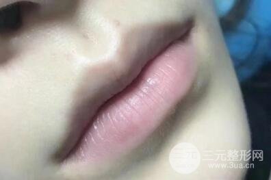 纹唇当天的情况介绍