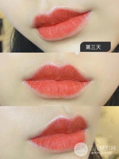 纹唇一到七天恢复图片参考,诱人唇色片刻拥有!-三元整形网