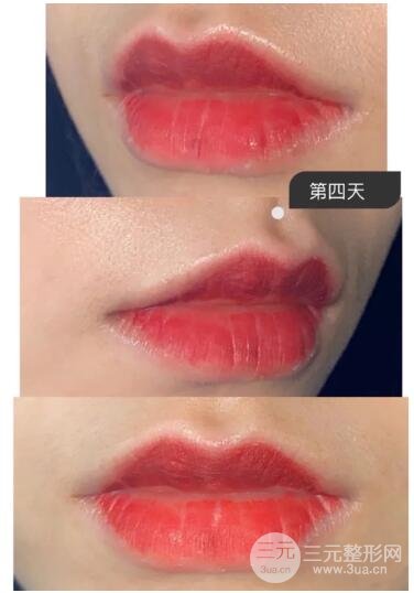纹唇后第三天的情况