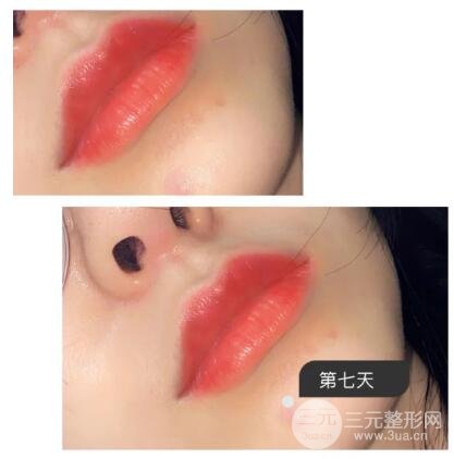 纹唇后一周的情况