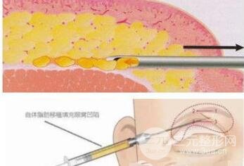 眼窝填充术过程